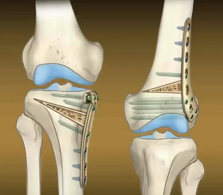 Düzeltici Osteotomi: Kemik Eğriliklerinin Tedavisinde Cerrahi Çözüm
